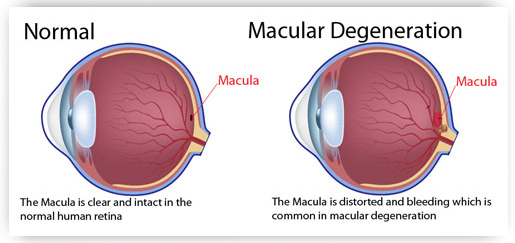 normal vs macular degeneration