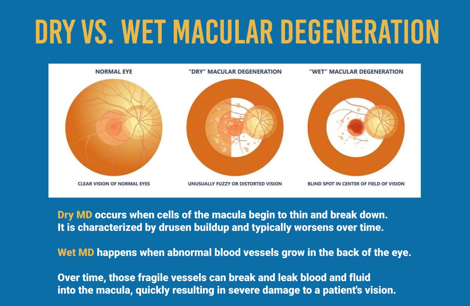 Understanding Macular Degeneration: A Comprehensive Guide - EyeLand Vision